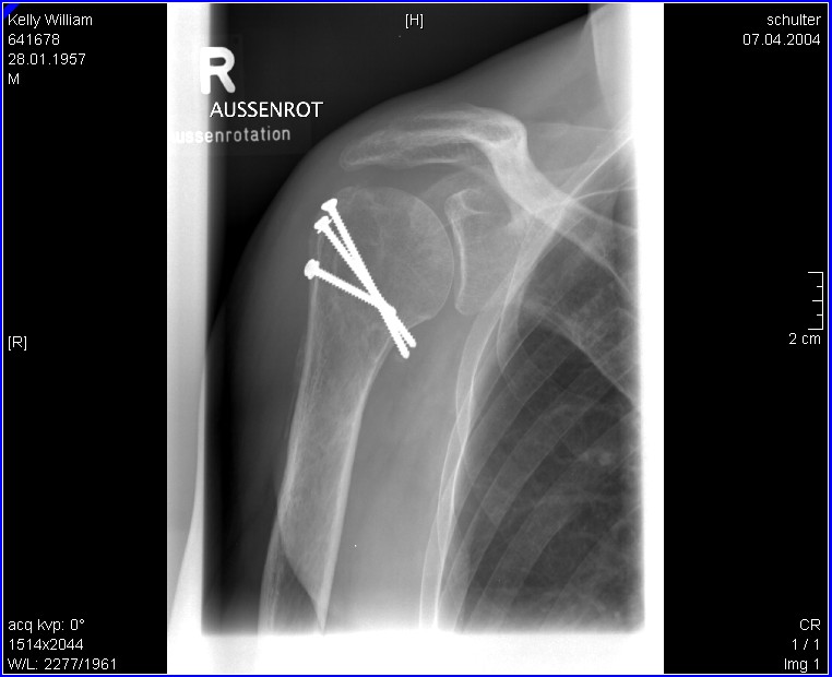post-operation